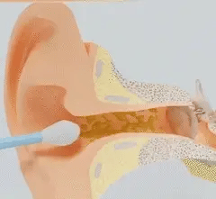 Nettoyeur d'oreille Vepulenssia™