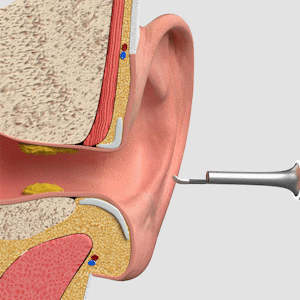 Nettoyeur d'oreille Vepulenssia™