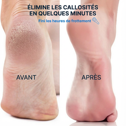 SmoothFeet™ - Râpe à pieds élimine les callosités des pieds