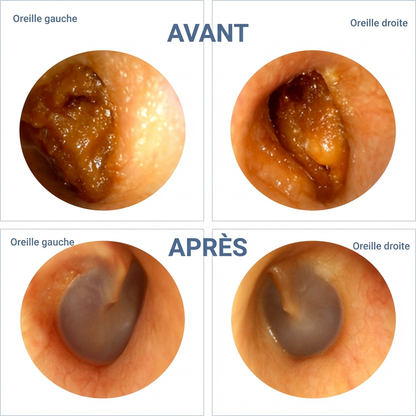 Nettoyeur d'oreille Vepulenssia™